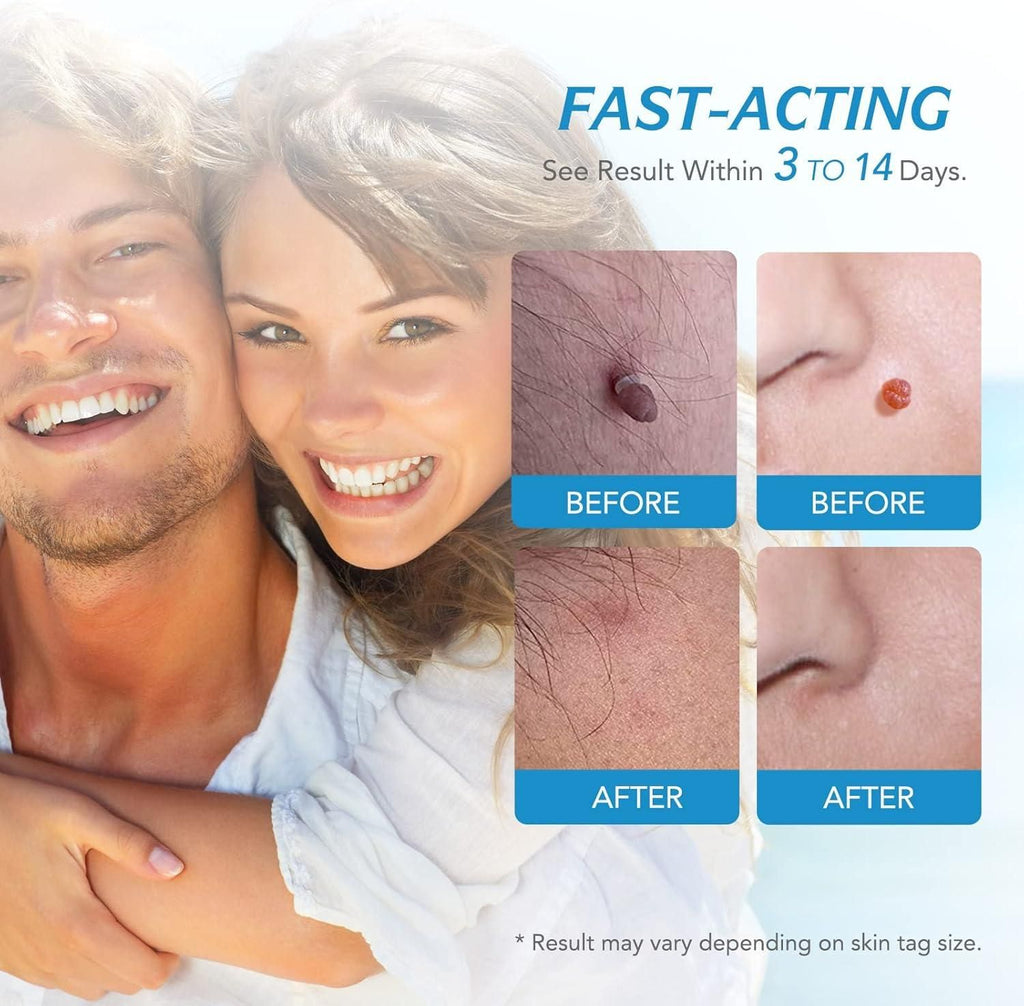2 in 1 Skin Tag Remover Kit - Painless - Style Elevates