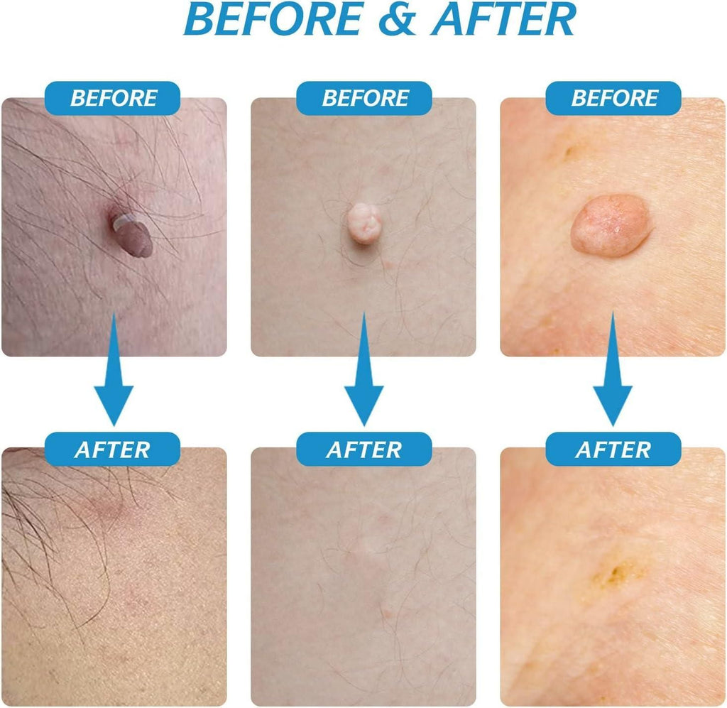 2 in 1 Skin Tag Remover Kit - Painless - Style Elevates