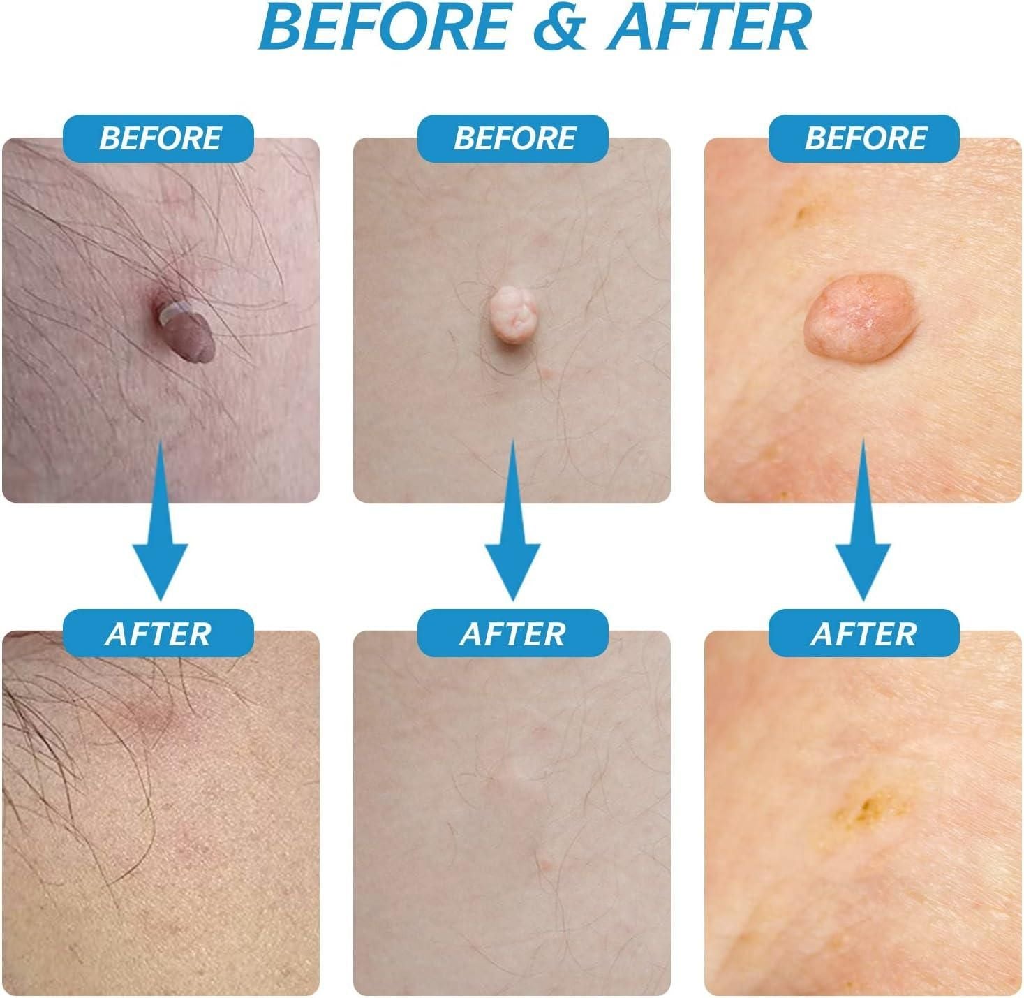 2 in 1 Skin Tag Remover Kit - Painless - Style Elevates