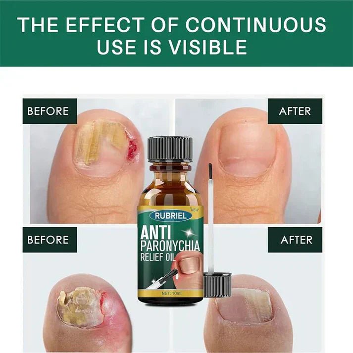 Anti-Paronychia Nail Relief Oil 🔥 - Style Elevates