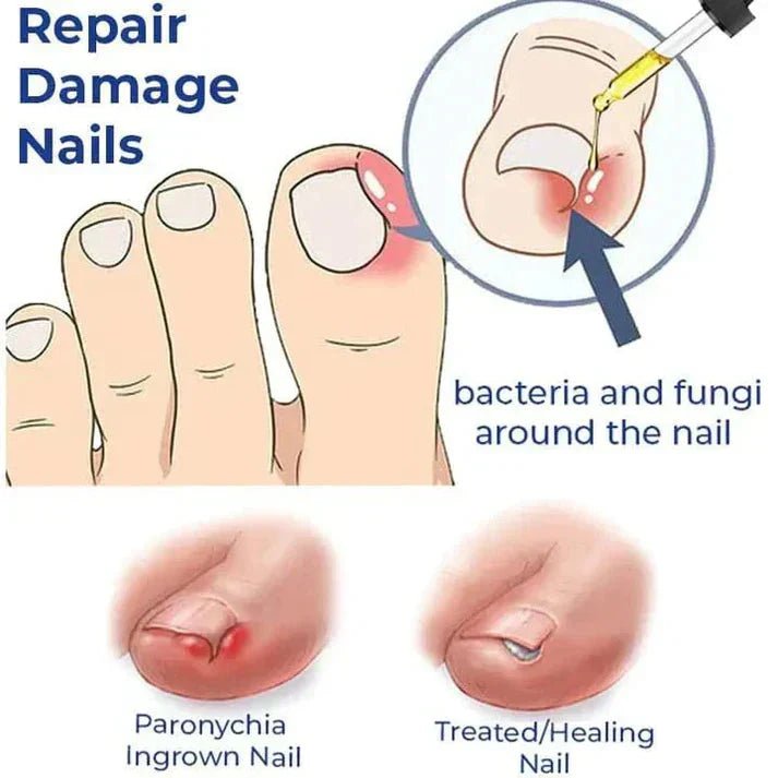Anti-Paronychia Nail Relief Oil 🔥 - Style Elevates