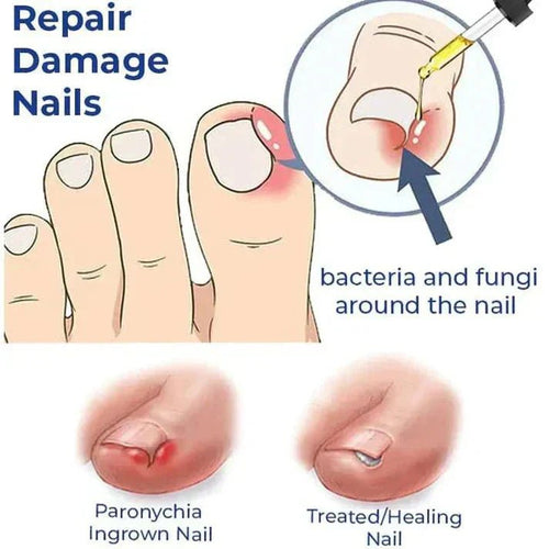 Anti-Paronychia Nail Relief Oil 🔥 - Style Elevates