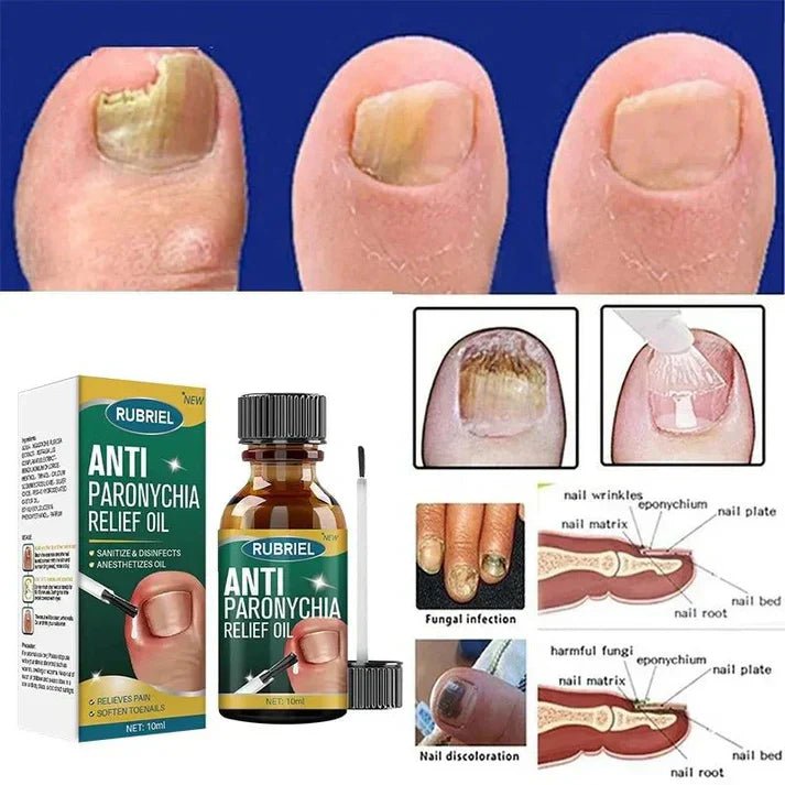 Anti-Paronychia Nail Relief Oil 🔥 - Style Elevates