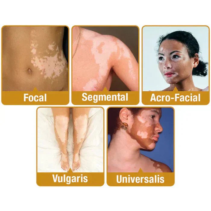 Bee Venom Vitigo Correcting Cream - (Pack of 2) - Style Elevates