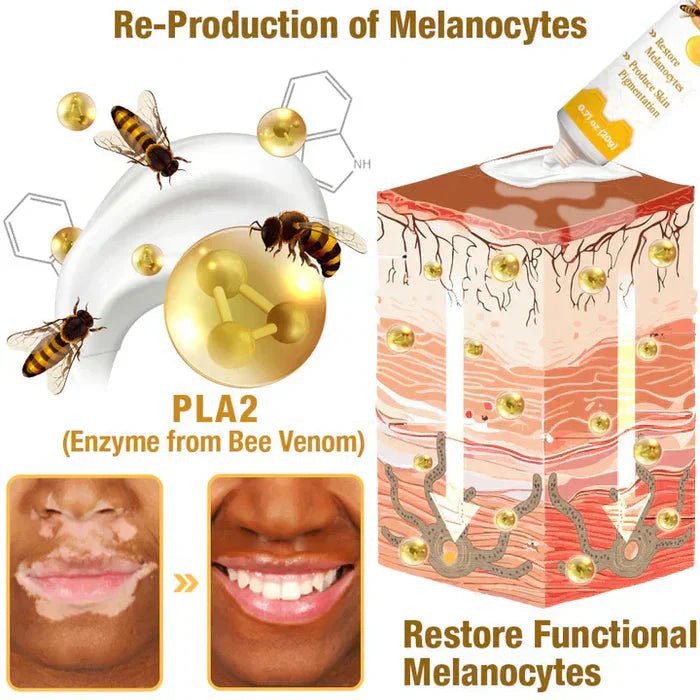Bee Venom Vitigo Correcting Cream - (Pack of 2) - Style Elevates