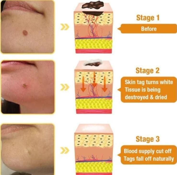 Bee Venom Wart Remover Spray 30ml - Style Elevates