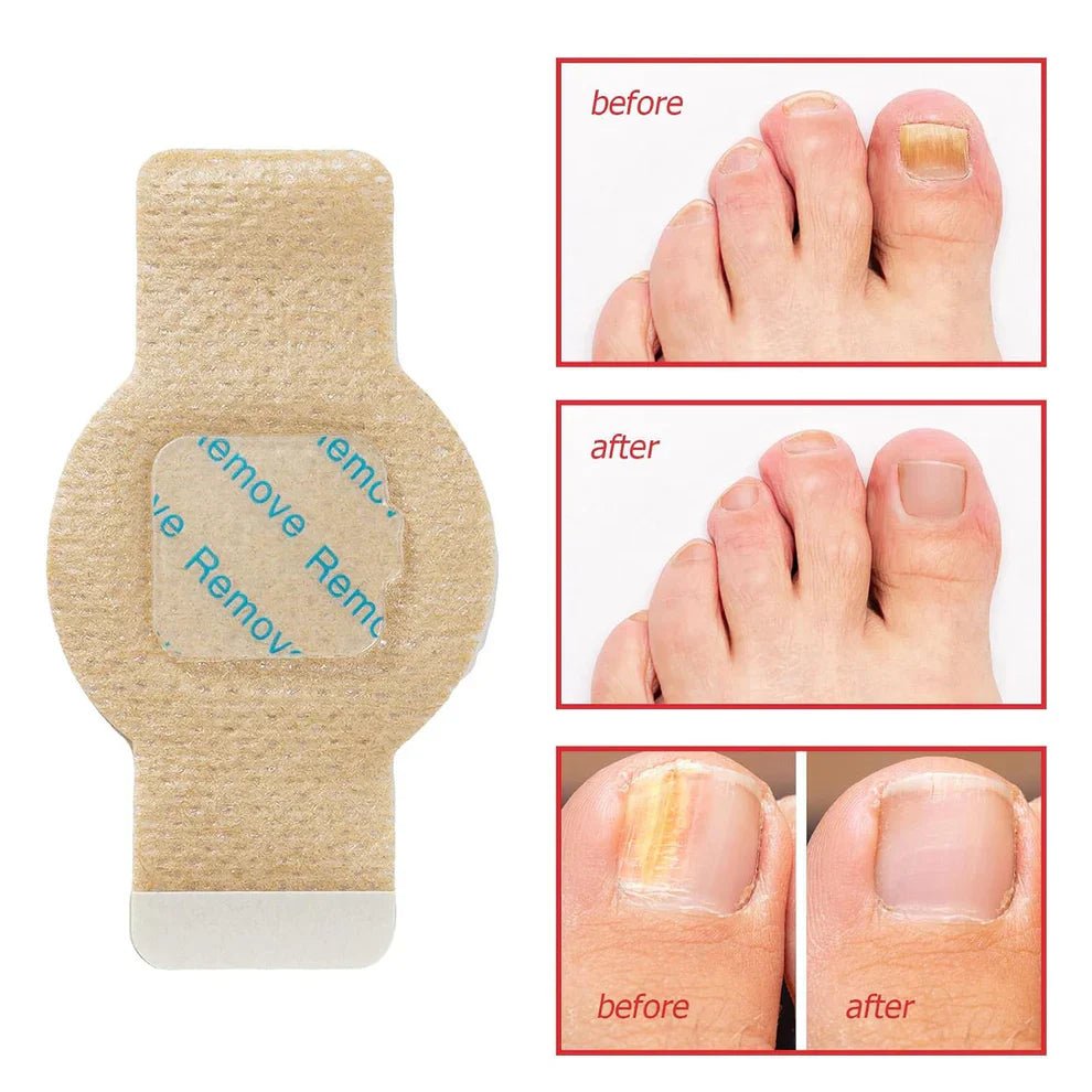 NailHeal™ - Fungal Nail Patches - Style Elevates