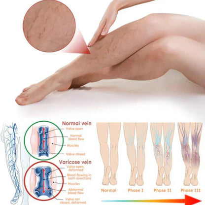 Varicose Veins Treatment Spray(Buy 1 Get 1 Free)