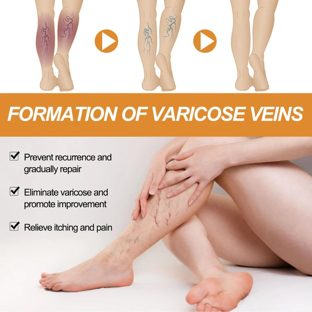 Varicose Veins Treatment Spray(Buy 1 Get 1 Free)